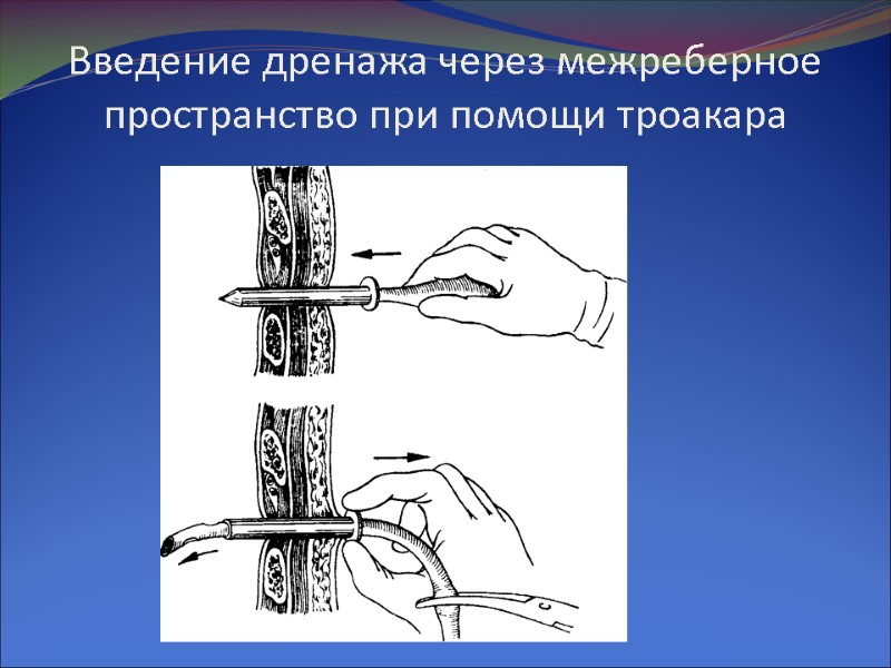 Введение дренажа через межреберное пространство при помощи троакара